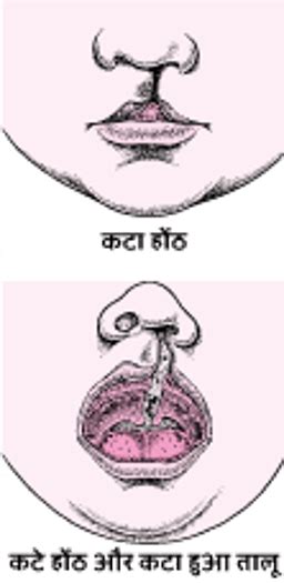 कटे होंठ और कटे तालू - बच्चों से संबंधित स्वास्थ्य समस्याएं - MSD ...