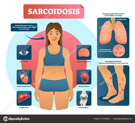 Is Sarcoidosis An Autoimmune Disease