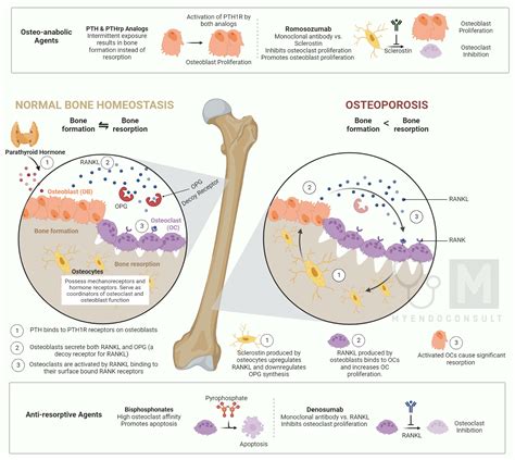 Osteomalacia vs Osteoporosis : Know The Difference – My Endo Consult