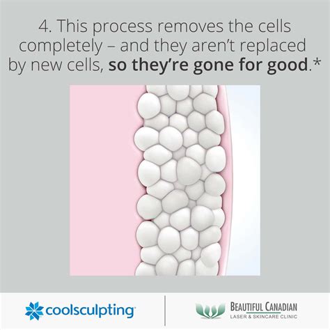 CoolSculpting® Vancouver w/ Cost Info | Fat Freezing in Surrey | BC Laser