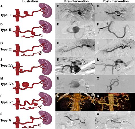 Treatment strategy for splenic artery aneurysms and novel ...