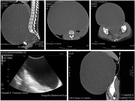 A giant intra-abdominal cyst | BMJ Case Reports