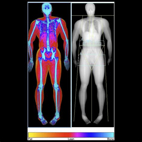Image result for Dexa Scan Interpretation