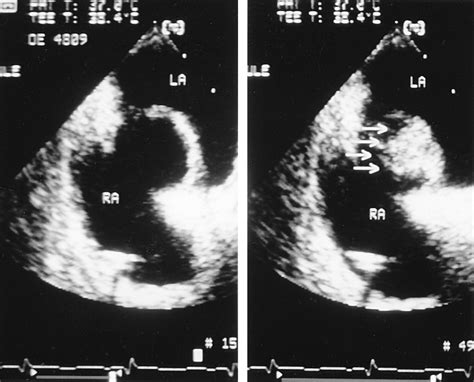 Atrial Septal Aneurysm in Adult Patients | Circulation