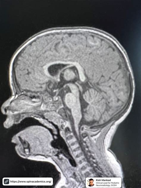Tip of the day 💡: The downsloping splenium of the corpus callosum can be a strong marker of an ...