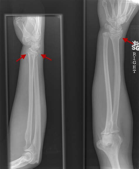 Ulnar Styloid Fracture
