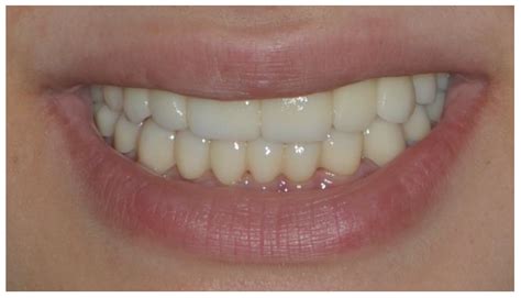 CAD/CAM Diagnostic Esthetic Functional Splint (DEFS) as a Removable ...
