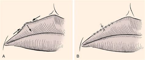 ADVANCEMENT FLAPS - Clinical Tree