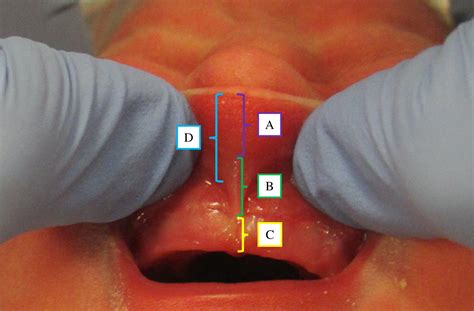 Frenectomy For Lip Tie