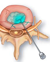 Image result for Lumbar Discogram