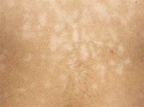 Tinea Versicolor in Babies and Children | BabyCenter