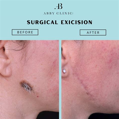 Surgical Excision - Dr Abby Clinic