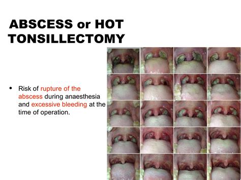 Quinsy or Peritonsillar Abscess.pptx