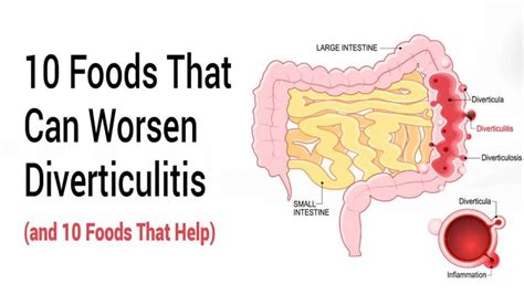 young people with diverticulitis
