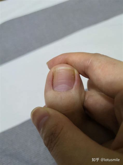 甲分离型灰指甲治愈过程 - 知乎