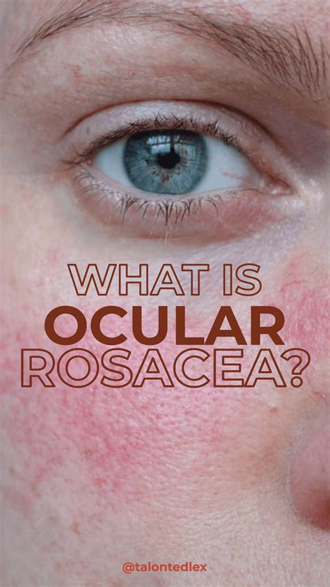 Ocular Rosacea: What is ocular rosacea, or rosacea type 4?