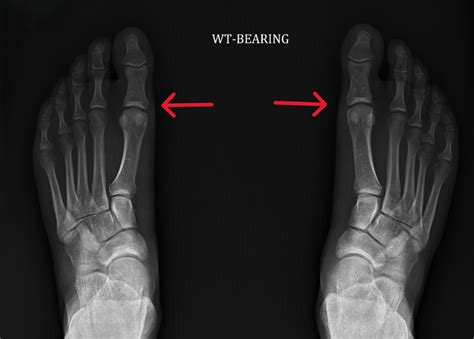 Turf toe: What athletes need to know about this painful injury | Orthopaedics | UT Southwestern ...