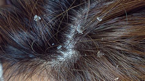 How To Remove Dry Scalp