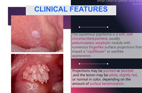 Benign tumors of oral cavity sonal | PPTX