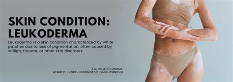 Leukoderma – Causes, Symptoms & Treatments for White Patches