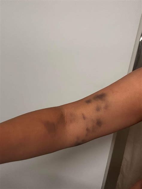 Plasma donating has left me in pain : r/medical_advice