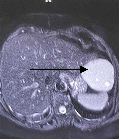 Laparoscopic Surgery: Laparoscopic Surgery for Liver Tumor ...