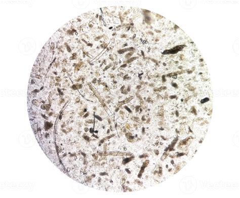 Granular Casts In Urine