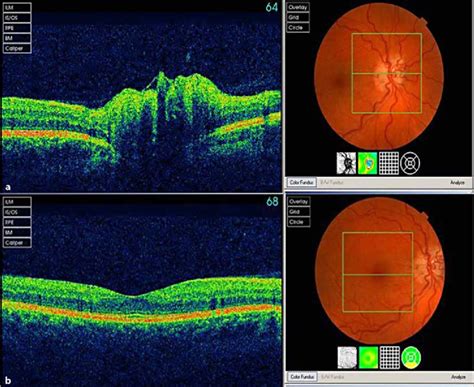 Monitoring Glaucoma Progression with OCT