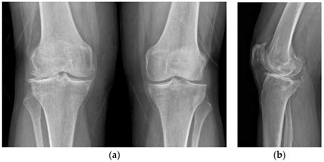 One-Stage Tricompartmental Hypoallergenic UKA for Tricompartmental ...