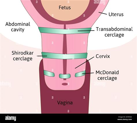 three types of Cervical cerclage or cervical stitch, treatment for ...