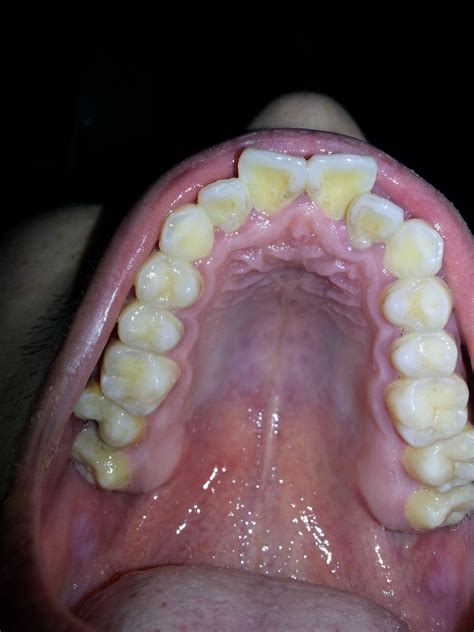 牙齿矫正 主要是门牙突出 是拔牙好还是磨牙好呢_百度知道
