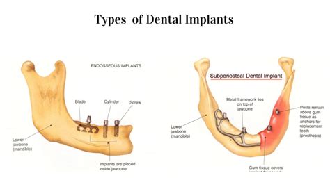 Image result for Different Types of Teeth Implants