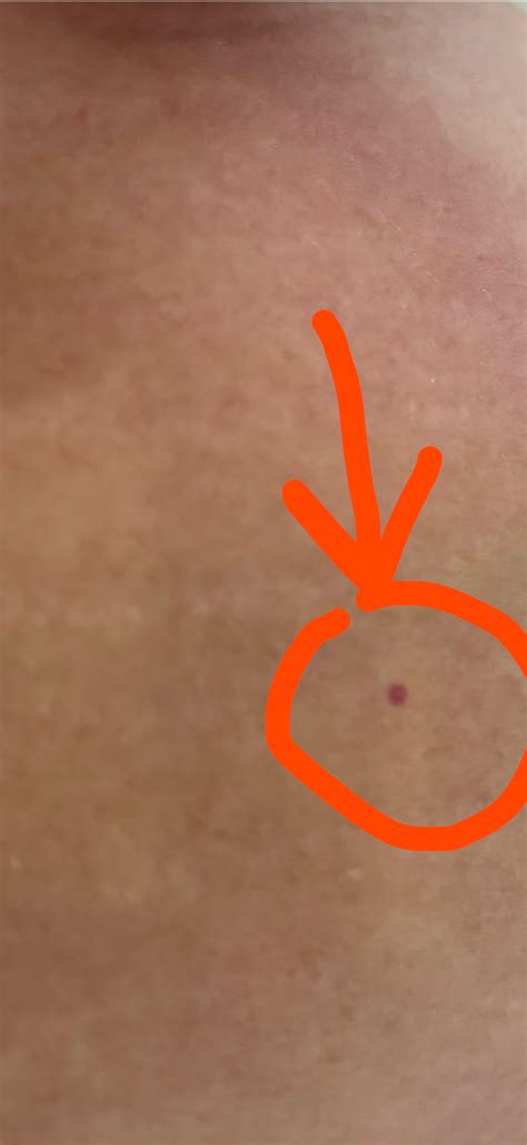 Tiny Purple-Red Dot After Sunburn? : r/DermatologyQuestions