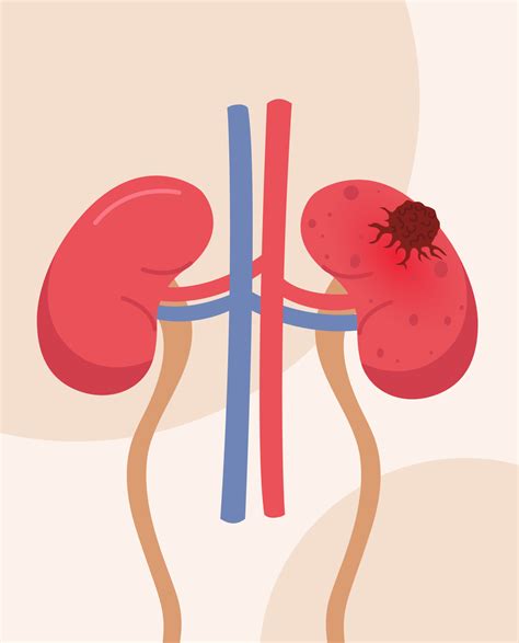 Kidney Cancer: A Guide to Types & Treatment - SynappseHealth