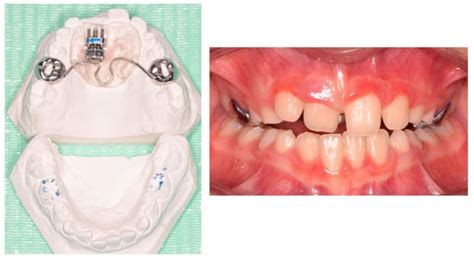 Pediatric Treatment of Anterior-Upper-Single Dental Crossbite Using a ...