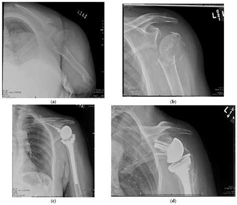 Management of Proximal Humerus Fractures in Adults—A Scoping Review