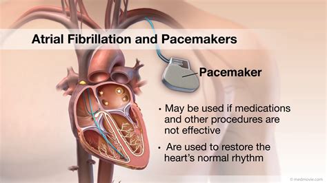 Does A Pacemaker Correct An Irregular Heartbeat at Jason Rocha blog