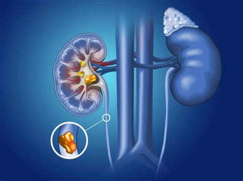 रीनल कोलिक (Renal Colic) के बारे में पाएं पूरी जानकारी - हैलो स्वास्थ्य