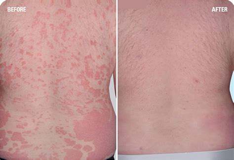 Skyrizi Side Effects