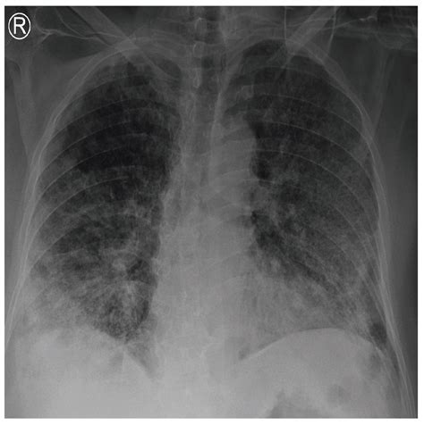 Detection of COVID-19 from Chest X-ray Images Using Deep Convolutional ...