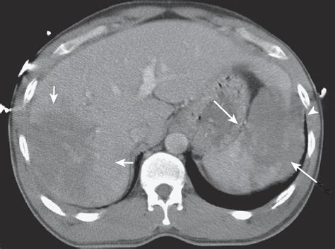 Splenic Trauma and Surgery - Clinical Tree