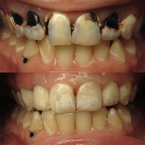Case Presentation: Mountain Dew Mouth Reconstruction