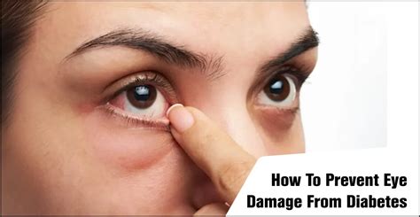 Diabetic Eye Problems 的图像结果