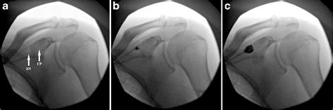 Image result for Shoulder Injection Fluoroscopy