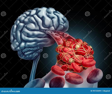 What Are The Symptoms Of Clot In Brain at Marion Akers blog