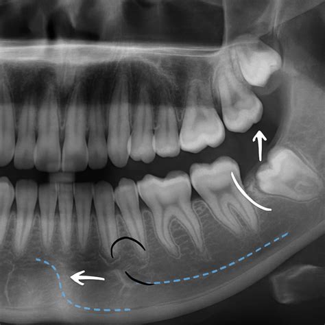 Wisdom Teeth Function 的图像结果