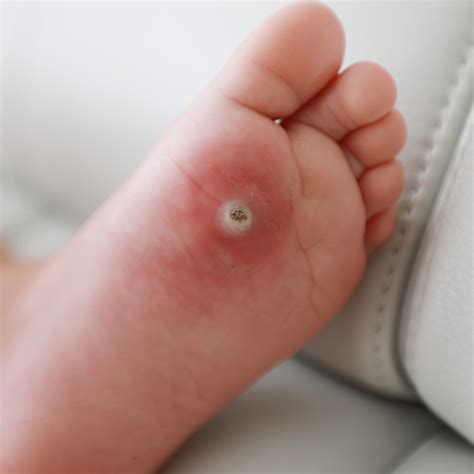 What The Wart? Types, and Treatments - Radiance Cosmetics