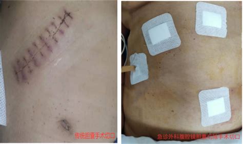 郑州市紧急医疗救援中心-我院急诊科独立完成腹腔镜胆囊切除术