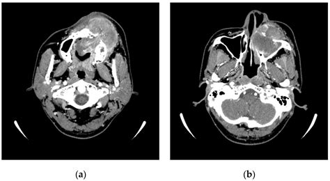 Virtual Reality Simulation and Augmented Reality-Guided Surgery for ...