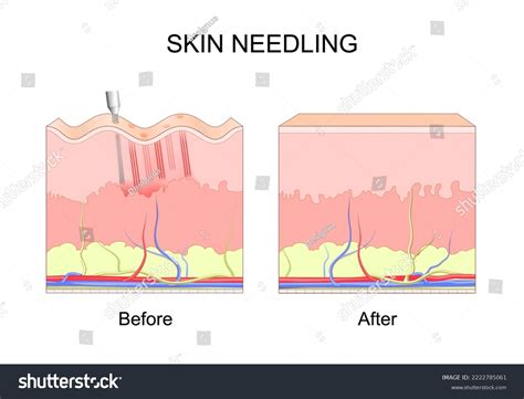Microneedling Skin Needling Before After Cosmetic Stock Vector (Royalty Free) 2222785061 ...